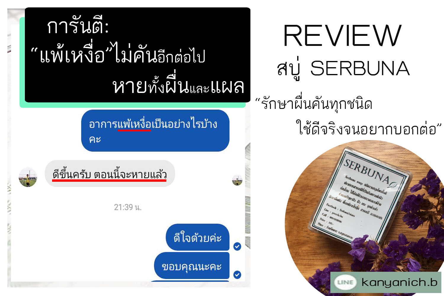 แพ้เหงื่อ
